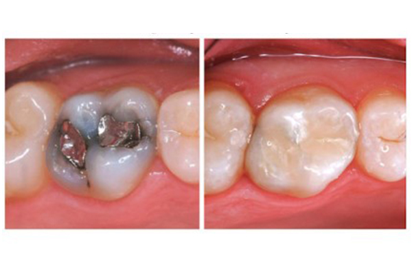 Composite filling