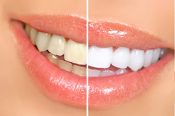 Teeth whitening